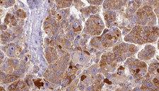 GPR146 Antibody - 1:100 staining human liver carcinoma tissues by IHC-P. The sample was formaldehyde fixed and a heat mediated antigen retrieval step in citrate buffer was performed. The sample was then blocked and incubated with the antibody for 1.5 hours at 22°C. An HRP conjugated goat anti-rabbit antibody was used as the secondary.