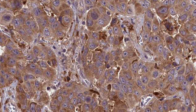 GPR148 Antibody - 1:100 staining human liver carcinoma tissues by IHC-P. The sample was formaldehyde fixed and a heat mediated antigen retrieval step in citrate buffer was performed. The sample was then blocked and incubated with the antibody for 1.5 hours at 22°C. An HRP conjugated goat anti-rabbit antibody was used as the secondary.