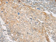 GPR151 Antibody - Immunohistochemistry of paraffin-embedded Human cervical cancer tissue  using GPR151 Polyclonal Antibody at dilution of 1:45(×200)