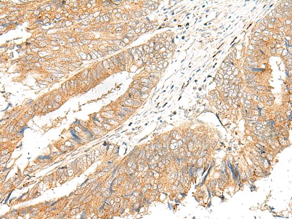 GPR151 Antibody - Immunohistochemistry of paraffin-embedded Human colorectal cancer tissue  using GPR151 Polyclonal Antibody at dilution of 1:45(×200)