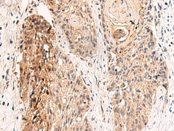 GPR152 Antibody - Immunohistochemistry of paraffin-embedded Human esophagus cancer tissue  using GPR152 Polyclonal Antibody at dilution of 1:45(×200)