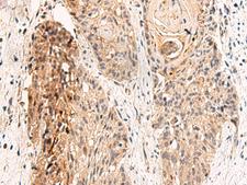 GPR152 Antibody - Immunohistochemistry of paraffin-embedded Human esophagus cancer tissue  using GPR152 Polyclonal Antibody at dilution of 1:45(×200)