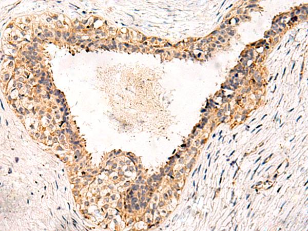 GPR152 Antibody - Immunohistochemistry of paraffin-embedded Human breast cancer tissue  using GPR152 Polyclonal Antibody at dilution of 1:55(×200)