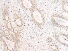 GPR157 Antibody - Immunohistochemistry of paraffin-embedded Human breast cancer tissue  using GPR157 Polyclonal Antibody at dilution of 1:60(×200)