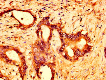 GPR158 Antibody - Immunohistochemistry image at a dilution of 1:500 and staining in paraffin-embedded human colon cancer performed on a Leica BondTM system. After dewaxing and hydration, antigen retrieval was mediated by high pressure in a citrate buffer (pH 6.0) . Section was blocked with 10% normal goat serum 30min at RT. Then primary antibody (1% BSA) was incubated at 4 °C overnight. The primary is detected by a biotinylated secondary antibody and visualized using an HRP conjugated SP system.