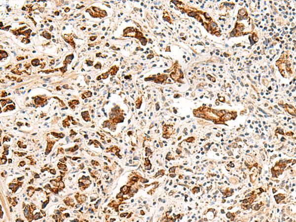 GPR160 Antibody - Immunohistochemistry of paraffin-embedded Human prost at e cancer tissue  using GPR160 Polyclonal Antibody at dilution of 1:35(×200)