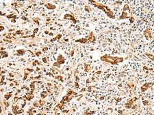 GPR160 Antibody - Immunohistochemistry of paraffin-embedded Human prost at e cancer tissue  using GPR160 Polyclonal Antibody at dilution of 1:35(×200)