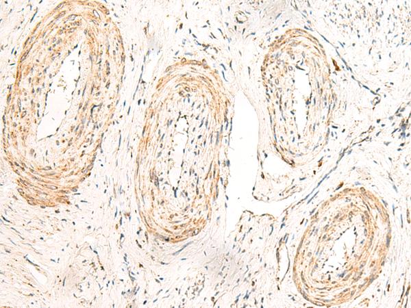 GPR160 Antibody - Immunohistochemistry of paraffin-embedded Human cervical cancer tissue  using GPR160 Polyclonal Antibody at dilution of 1:35(×200)