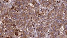 GPR161 Antibody - 1:100 staining human liver carcinoma tissues by IHC-P. The sample was formaldehyde fixed and a heat mediated antigen retrieval step in citrate buffer was performed. The sample was then blocked and incubated with the antibody for 1.5 hours at 22°C. An HRP conjugated goat anti-rabbit antibody was used as the secondary.