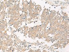 GPR161 Antibody - Immunohistochemistry of paraffin-embedded Human lung cancer tissue  using GPR161 Polyclonal Antibody at dilution of 1:40(×200)