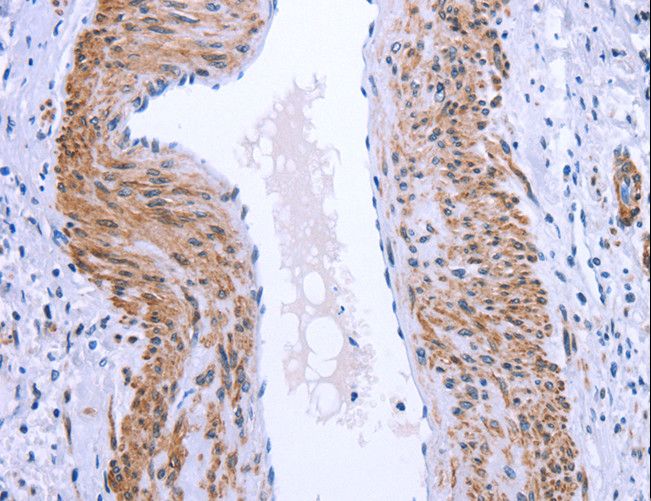 GPR171 Antibody - Immunohistochemistry of paraffin-embedded Human cervical cancer using GPR171 Polyclonal Antibody at dilution of 1:25.