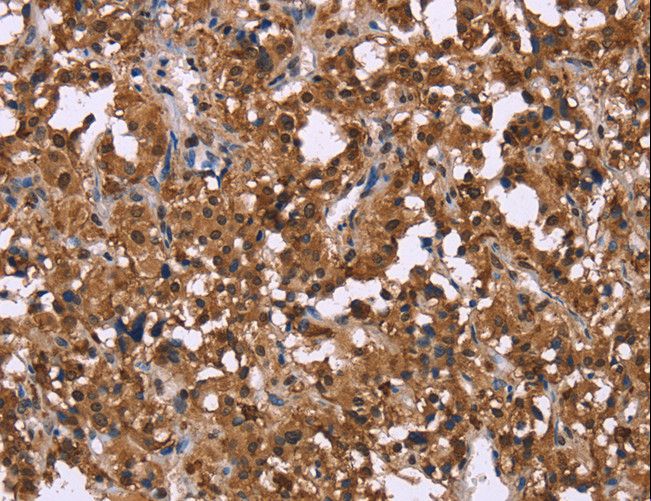 GPR171 Antibody - Immunohistochemistry of paraffin-embedded Human liver cancer using GPR171 Polyclonal Antibody at dilution of 1:40.