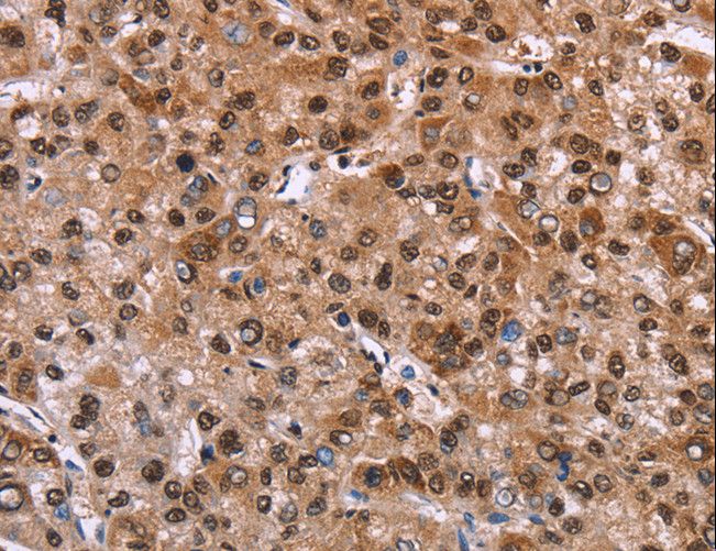 GPR171 Antibody - Immunohistochemistry of paraffin-embedded Human liver cancer using GPR171 Polyclonal Antibody at dilution of 1:40.