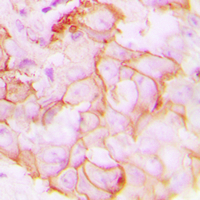 GPR20 Antibody - Immunohistochemical analysis of GPR20 staining in human breast cancer formalin fixed paraffin embedded tissue section. The section was pre-treated using heat mediated antigen retrieval with sodium citrate buffer (pH 6.0). The section was then incubated with the antibody at room temperature and detected using an HRP conjugated compact polymer system. DAB was used as the chromogen. The section was then counterstained with hematoxylin and mounted with DPX.