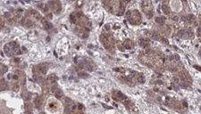 GPR20 Antibody - 1:100 staining human liver carcinoma tissues by IHC-P. The sample was formaldehyde fixed and a heat mediated antigen retrieval step in citrate buffer was performed. The sample was then blocked and incubated with the antibody for 1.5 hours at 22°C. An HRP conjugated goat anti-rabbit antibody was used as the secondary.