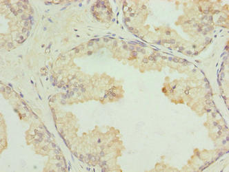 GPR21 Antibody - Immunohistochemistry of paraffin-embedded human prostate cancer using GPR21 Antibody at dilution of 1:100