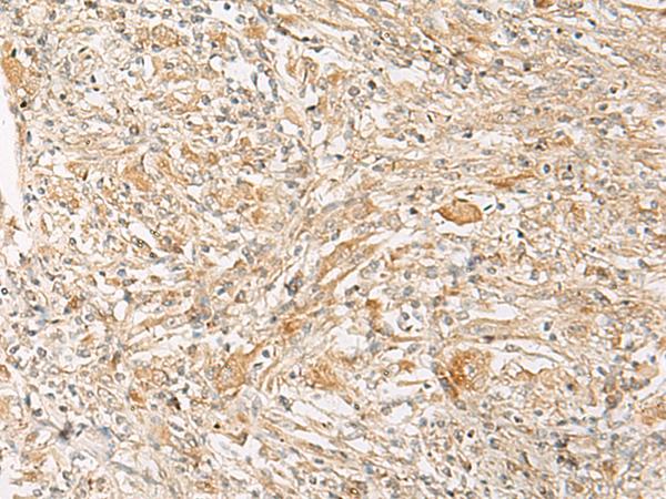 GPR22 Antibody - Immunohistochemistry of paraffin-embedded Human liver cancer tissue  using GPR22 Polyclonal Antibody at dilution of 1:50(×200)
