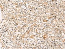 GPR22 Antibody - Immunohistochemistry of paraffin-embedded Human liver cancer tissue  using GPR22 Polyclonal Antibody at dilution of 1:50(×200)