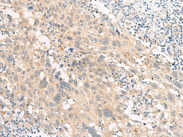 GPR22 Antibody - Immunohistochemistry of paraffin-embedded Human cervical cancer tissue  using GPR22 Polyclonal Antibody at dilution of 1:50(×200)