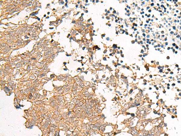 GPR22 Antibody - Immunohistochemistry of paraffin-embedded Human lung cancer tissue  using GPR22 Polyclonal Antibody at dilution of 1:50(×200)