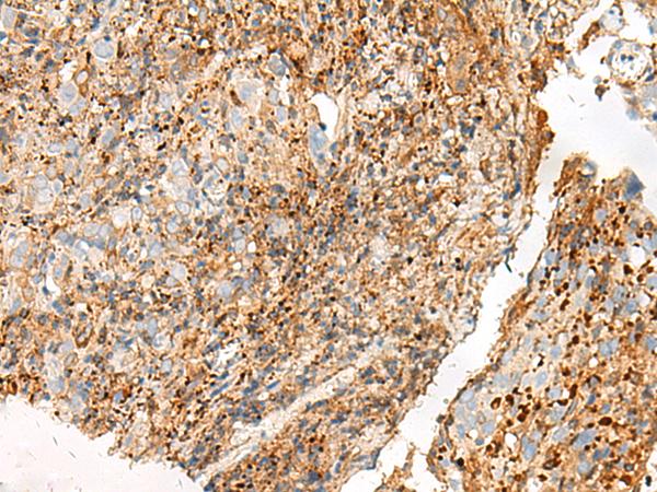 GPR27 Antibody - Immunohistochemistry of paraffin-embedded Human cervical cancer tissue  using GPR27 Polyclonal Antibody at dilution of 1:25(×200)