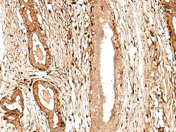 GPR27 Antibody - Immunohistochemistry of paraffin-embedded Human breast cancer tissue  using GPR27 Polyclonal Antibody at dilution of 1:60(×200)