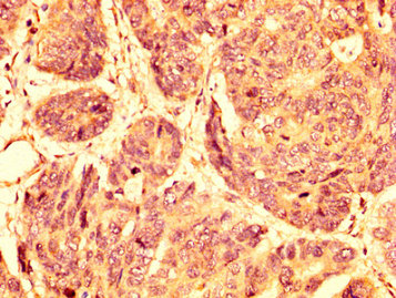 GPR32 Antibody - Immunohistochemistry image at a dilution of 1:500 and staining in paraffin-embedded human gastric cancer performed on a Leica BondTM system. After dewaxing and hydration, antigen retrieval was mediated by high pressure in a citrate buffer (pH 6.0) . Section was blocked with 10% normal goat serum 30min at RT. Then primary antibody (1% BSA) was incubated at 4 °C overnight. The primary is detected by a biotinylated secondary antibody and visualized using an HRP conjugated SP system.