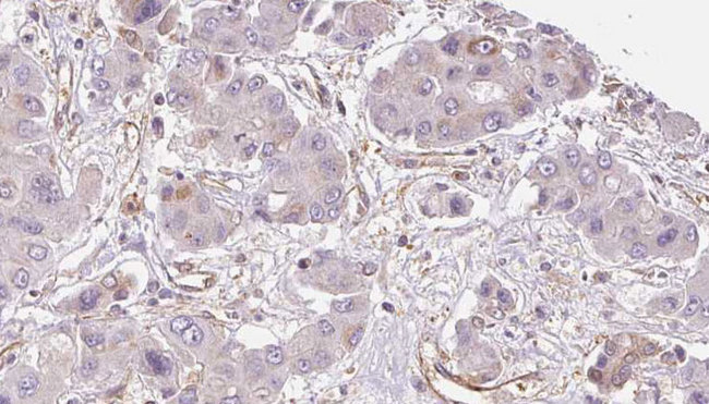 GPR33 Antibody - 1:100 staining human liver carcinoma tissues by IHC-P. The sample was formaldehyde fixed and a heat mediated antigen retrieval step in citrate buffer was performed. The sample was then blocked and incubated with the antibody for 1.5 hours at 22°C. An HRP conjugated goat anti-rabbit antibody was used as the secondary.