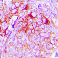 GPR34 Antibody - Immunohistochemical analysis of GPR34 staining in human breast cancer formalin fixed paraffin embedded tissue section. The section was pre-treated using heat mediated antigen retrieval with sodium citrate buffer (pH 6.0). The section was then incubated with the antibody at room temperature and detected using an HRP conjugated compact polymer system. DAB was used as the chromogen. The section was then counterstained with hematoxylin and mounted with DPX.