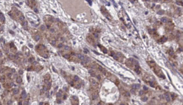 GPR39 Antibody - 1:100 staining human liver carcinoma tissues by IHC-P. The sample was formaldehyde fixed and a heat mediated antigen retrieval step in citrate buffer was performed. The sample was then blocked and incubated with the antibody for 1.5 hours at 22°C. An HRP conjugated goat anti-rabbit antibody was used as the secondary.