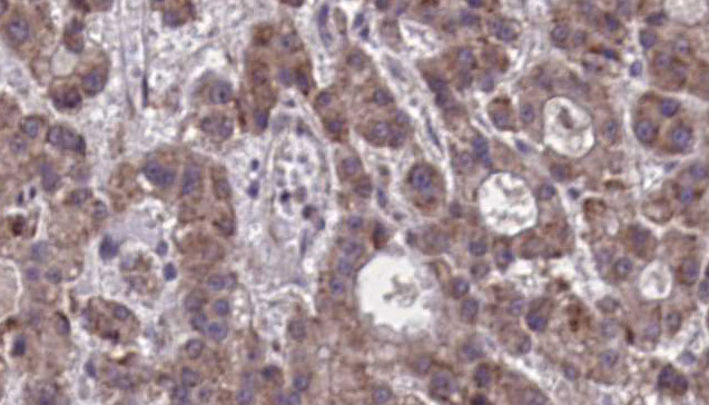 GPR44 / CRTH2 Antibody - 1:100 staining human liver carcinoma tissues by IHC-P. The sample was formaldehyde fixed and a heat mediated antigen retrieval step in citrate buffer was performed. The sample was then blocked and incubated with the antibody for 1.5 hours at 22°C. An HRP conjugated goat anti-rabbit antibody was used as the secondary.