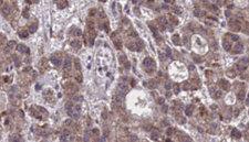 GPR44 / CRTH2 Antibody - 1:100 staining human liver carcinoma tissues by IHC-P. The sample was formaldehyde fixed and a heat mediated antigen retrieval step in citrate buffer was performed. The sample was then blocked and incubated with the antibody for 1.5 hours at 22°C. An HRP conjugated goat anti-rabbit antibody was used as the secondary.