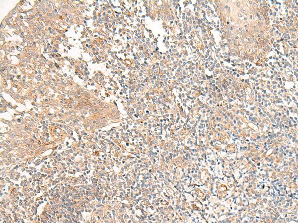 GPR44 / CRTH2 Antibody - Immunohistochemistry of paraffin-embedded Human tonsil tissue  using PTGDR2 Polyclonal Antibody at dilution of 1:30(×200)