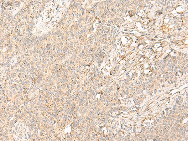 GPR44 / CRTH2 Antibody - Immunohistochemistry of paraffin-embedded Human ovarian cancer tissue  using PTGDR2 Polyclonal Antibody at dilution of 1:30(×200)