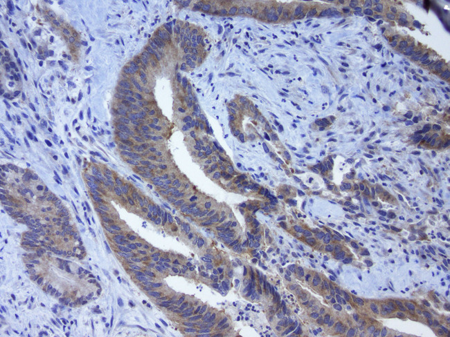 GPR49 / LGR5 Antibody - Immunohistochemical staining of paraffin-embedded human colon cancer using mouse anti-LGR5 clone UMAB210  at 1:400 with GBI Polink2 Broad HRP DAB detection kit. (D22-110); pretreatment of tissue prior to stain with heat-induced epitope retrieval buffer from GBI Labs TEE pH 9.0. (B21-100) using pressure chamber for 3 minutes at 110C is required for optimal staining. Shown here strong cytoplamic tumor cells.