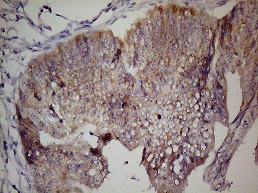 GPR49 / LGR5 Antibody - Immunohistochemical staining of paraffin-embedded Adenocarcinoma of Human colon tissue using anti-LGR5 Mouse monoclonal antibody. (Heat-induced epitope retrieval by 1mM EDTA in 10mM Tris buffer. (pH8.5) at 110C for 10 min. (1:150)
