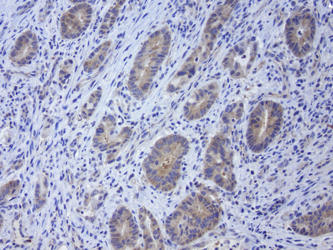 GPR49 / LGR5 Antibody - Immunohistochemical staining of paraffin-embedded human colon cancer using mouse anti-LGR5 clone UMAB211  at 1:400 with GBI Polink2 Broad HRP DAB detection kit. (D22-110); pretreatment of tissue prior to stain with heat-induced epitope retrieval buffer from GBI Labs TEE pH 9.0. (B21-100) using pressure chamber for 3 minutes at 110C is required for optimal staining. Shown here strong cytoplamic tumor cells.