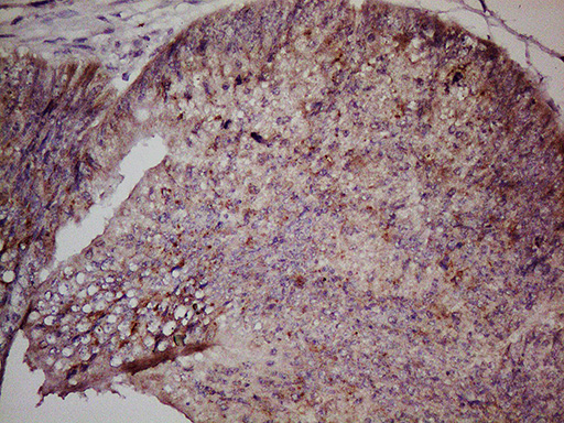 GPR49 / LGR5 Antibody - Immunohistochemical staining of paraffin-embedded Adenocarcinoma of Human colon tissue using anti-LGR5 mouse monoclonal antibody. (Heat-induced epitope retrieval by 1mM EDTA in 10mM Tris buffer. (pH8.5) at 110C for 10 min. (1:150)