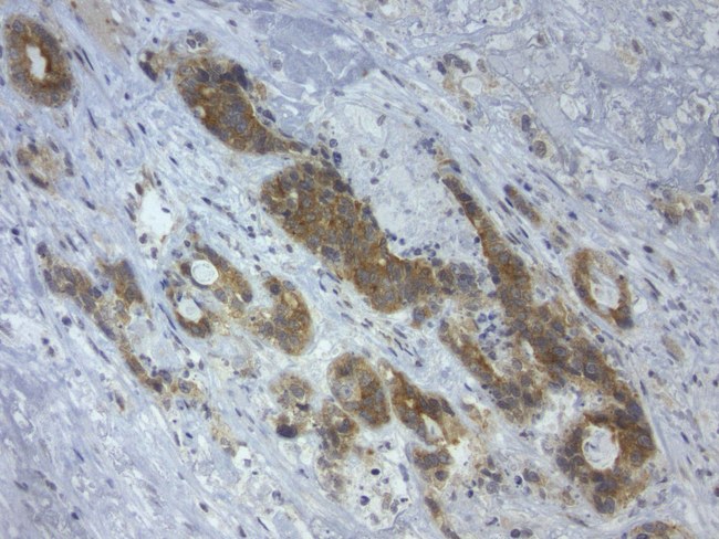 GPR49 / LGR5 Antibody - Immunohistochemical staining of paraffin-embedded human colon cancer using mouse anti-LGR5 clone UMAB212  at 1:400 with GBI Polink2 Broad HRP DAB detection kit. (D22-110); pretreatment of tissue prior to stain with heat-induced epitope retrieval buffer from GBI Labs TEE pH 9.0. (B21-100)using pressure chamber for 3 minutes at 110C is required for optimal staining. Shown here strong cytoplamic tumor cells.