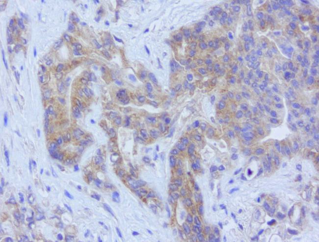 GPR49 / LGR5 Antibody - Immunohistochemical staining of paraffin-embedded human gastric cancer using mouse anti-LGR5 clone UMAB212  at 1:400 with GBI Polink2 Broad HRP DAB detection kit. (D22-110); pretreatment of tissue prior to stain with heat-induced epitope retrieval buffer from GBI Labs TEE pH 9.0. (B21-100) using pressure chamber for 3 minutes at 110C is required for optimal staining. Shown here strong cytoplamic tumor cells.