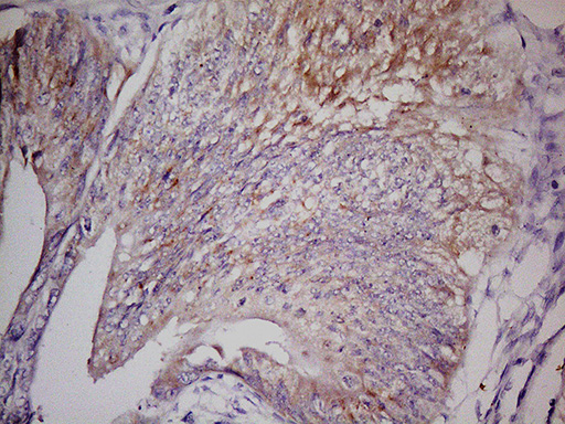 GPR49 / LGR5 Antibody - Immunohistochemical staining of paraffin-embedded Adenocarcinoma of Human colon tissue using anti-LGR5 mouse monoclonal antibody. (Heat-induced epitope retrieval by 1mM EDTA in 10mM Tris buffer. (pH8.5) at 110C for 10 min. (1:150)