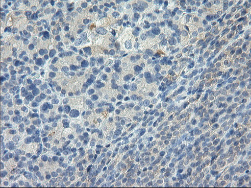 GPR49 / LGR5 Antibody - Immunohistochemical staining of paraffin-embedded Carcinoma of Human thyroid tissue using anti-LGR5 mouse monoclonal antibody. (Heat-induced epitope retrieval by 10mM citric buffer, pH6.0, 100C for 10min,