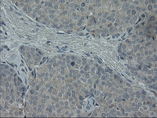 GPR49 / LGR5 Antibody - Immunohistochemical staining of paraffin-embedded Adenocarcinoma of Human breast tissue using anti-LGR5 mouse monoclonal antibody. (Heat-induced epitope retrieval by 10mM citric buffer, pH6.0, 100C for 10min,