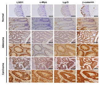 GPR49 / LGR5 Antibody - Figure from citation: Positive correlation between LSD1, c-Myc, ß-catenin and LGR5 expression in human colorectal tumor tissues. Expression levels of LSD1, LGR5, ß-catenin and c-Myc in consecutive sections from normal colon, adenoma and CRC tumor tissues. Dilution: 1:100