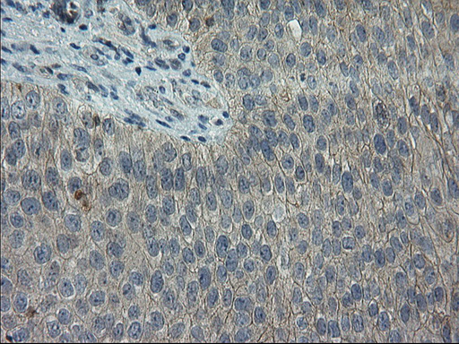 GPR49 / LGR5 Antibody - Immunohistochemical staining of paraffin-embedded Carcinoma of Human bladder tissue using anti-LGR5 mouse monoclonal antibody. (Heat-induced epitope retrieval by 10mM citric buffer, pH6.0, 100C for 10min,