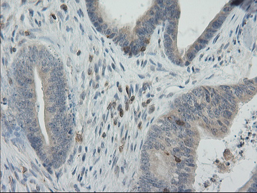 GPR49 / LGR5 Antibody - Immunohistochemical staining of paraffin-embedded Adenocarcinoma of Human colon tissue using anti-LGR5 mouse monoclonal antibody. (Heat-induced epitope retrieval by 10mM citric buffer, pH6.0, 100C for 10min,