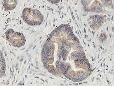 GPR49 / LGR5 Antibody - IHC of paraffin-embedded Adenocarcinoma of Human colon tissue using anti-LGR5 mouse monoclonal antibody. (Heat-induced epitope retrieval by 10mM citric buffer, pH6.0, 100C for 10min).