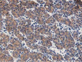 GPR49 / LGR5 Antibody - IHC of paraffin-embedded Carcinoma of Human thyroid tissue using anti-LGR5 mouse monoclonal antibody. (Heat-induced epitope retrieval by 10mM citric buffer, pH6.0, 100C for 10min).