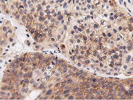 GPR49 / LGR5 Antibody - IHC of paraffin-embedded Carcinoma of Human bladder tissue using anti-LGR5 mouse monoclonal antibody. (Heat-induced epitope retrieval by 10mM citric buffer, pH6.0, 100C for 10min).