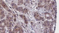 GPR55 Antibody - 1:100 staining human liver carcinoma tissues by IHC-P. The sample was formaldehyde fixed and a heat mediated antigen retrieval step in citrate buffer was performed. The sample was then blocked and incubated with the antibody for 1.5 hours at 22°C. An HRP conjugated goat anti-rabbit antibody was used as the secondary.